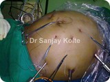 lap repair of rec umbilical hernia 1l
